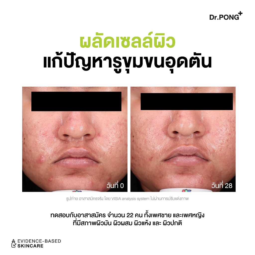 ภาพเพิ่มเติมของ Refill pack 300 ml Dr.PONG p55 BHA Acne Clear face wash เจลล้างหน้าสูตรอ่อนโยน