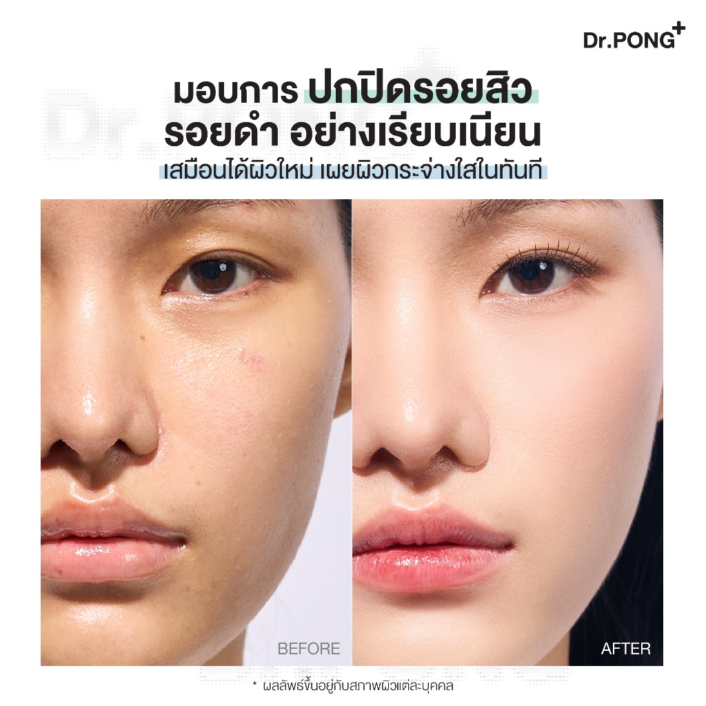 ภาพเพิ่มเติมของ [1 ฟรี 1] คุชชั่นลดสิว Dr.PONG ACNE ACE LONGWEAR CUSHION คุมมัน ติดทนกันน้ำ ไม่หลุดง่าย ยืนยันด้วยงานวิจัย