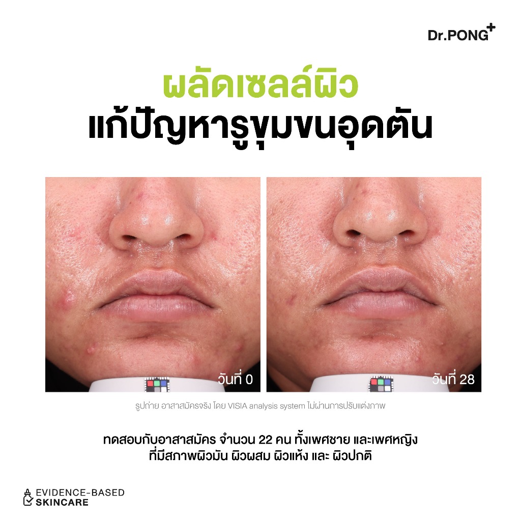 ภาพเพิ่มเติมของ Dr.PONG P55 ACNE CLEAR FACE WASH เจลล้างหน้าลดสิว สูตรอ่อนโยน สิวลดจริง ลดการอุดตัน ยืนยันด้วยงานวิจัย