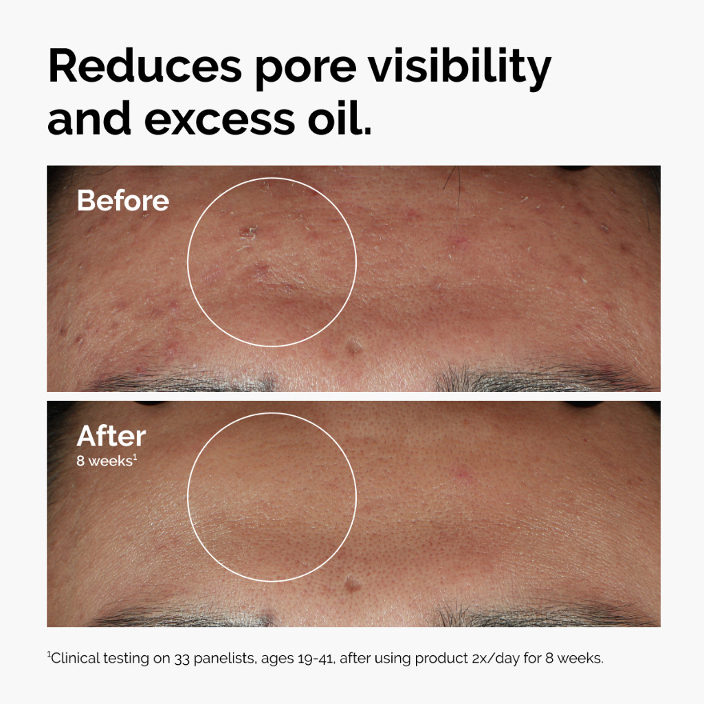 ภาพเพิ่มเติมของ The Ordinary Niacinamide 10% + Zinc 1% | เซรั่มลดการเกิดสิว กระชับรูขุมขน ลดความมัน ผิวแลดูกระจ่างใส